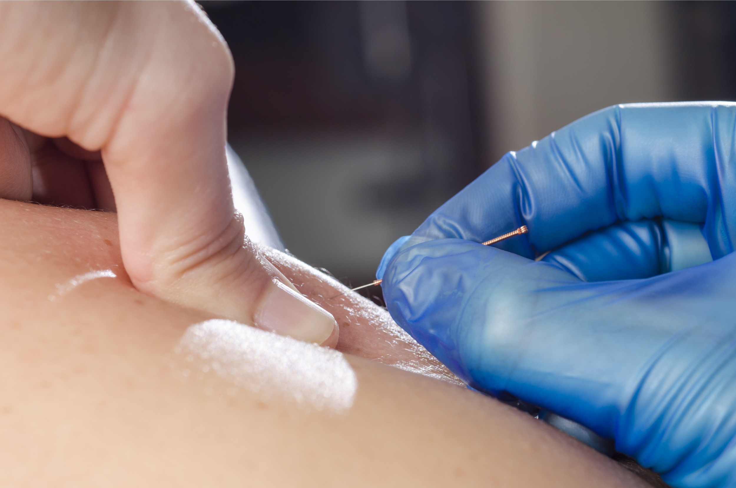 Electrical stimulation with dry needling