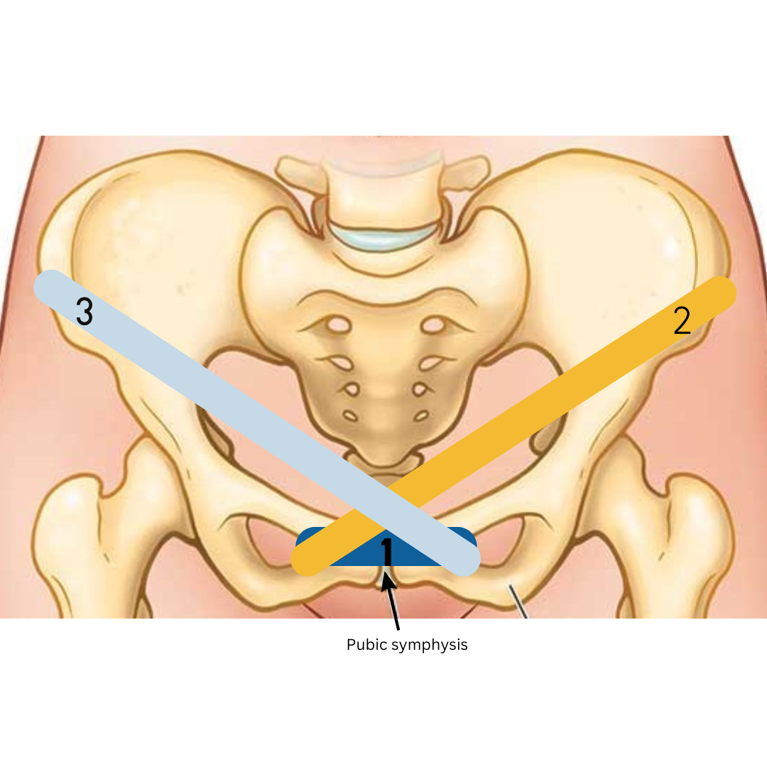 Kinesiotape for symphysis pubis pain