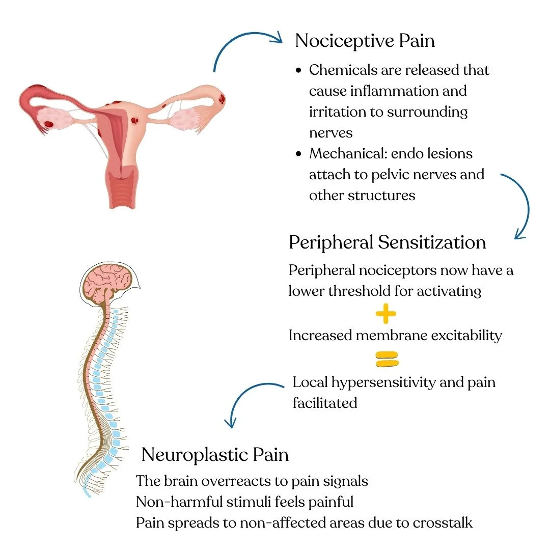 endometriosis chronic nociplastic pain pelvic floor physical therapy
