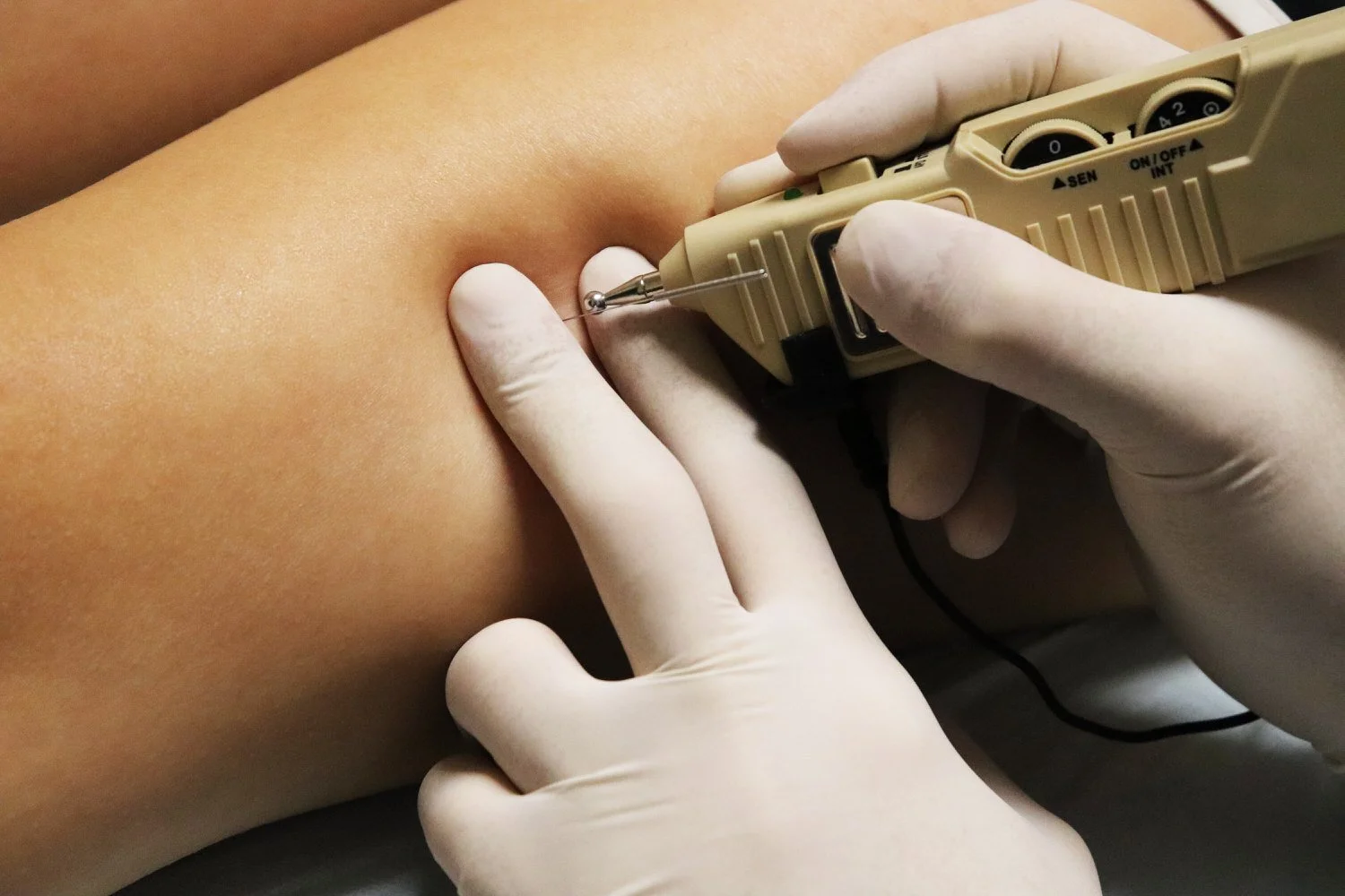 Dry needling trigger point release