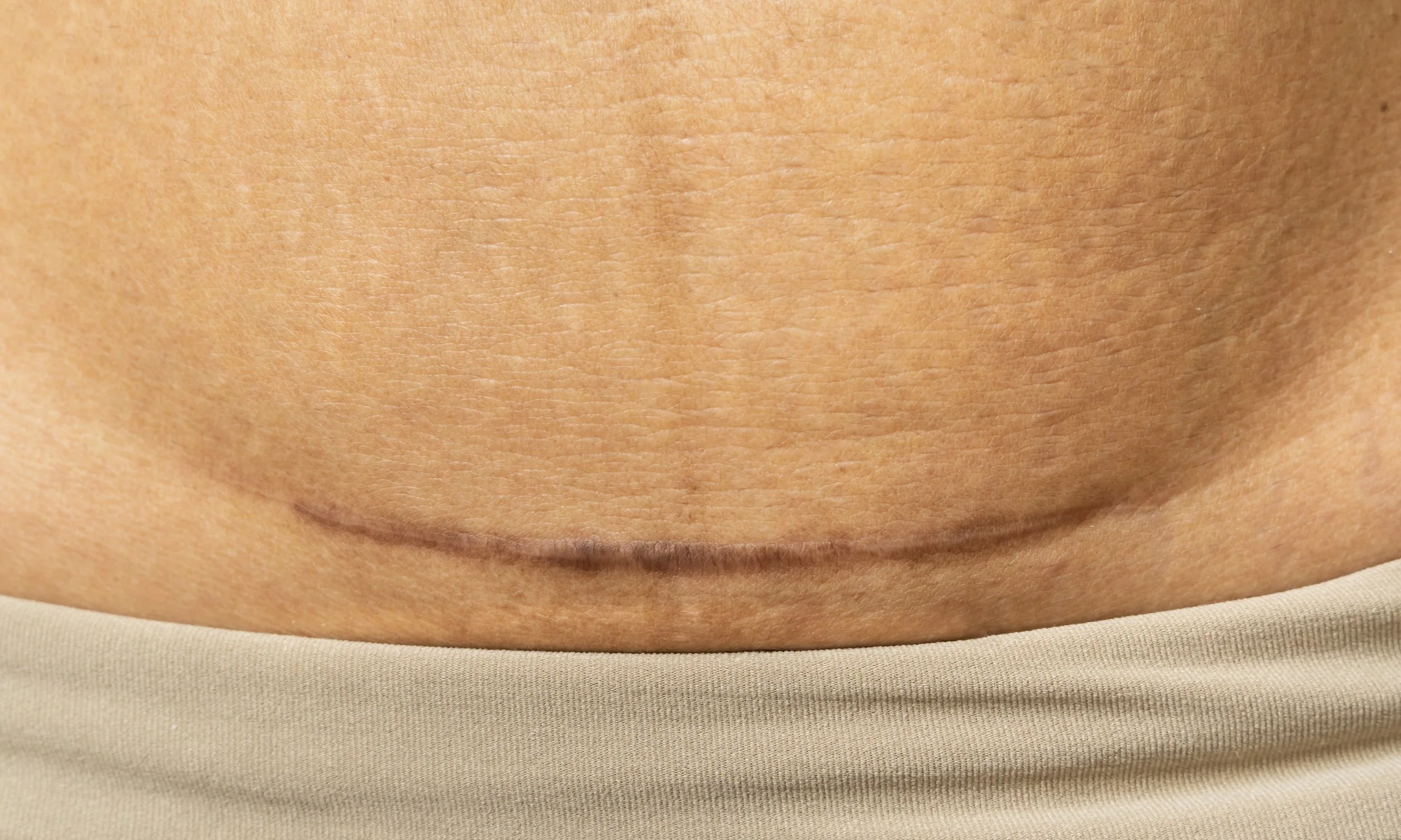 cesarean scar massage postpartum cesarean birth