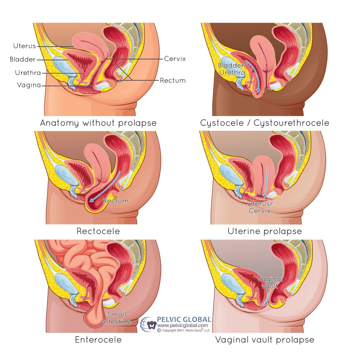 types of prolapse pelvic floor physical therapy